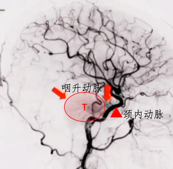 該腫瘤周圍環(huán)繞有豐富的血管結(jié)構(gòu)，主要包括咽升動脈以及頸內(nèi)動脈硬腦膜分支。在手術(shù)過程中，這些血管容易受到損傷，從而導(dǎo)致出血。