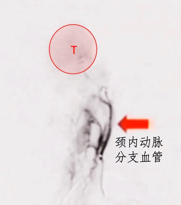 該腫瘤周圍環(huán)繞有豐富的血管結(jié)構(gòu)，主要包括咽升動脈以及頸內(nèi)動脈硬腦膜分支。在手術(shù)過程中，這些血管容易受到損傷，從而導(dǎo)致出血。