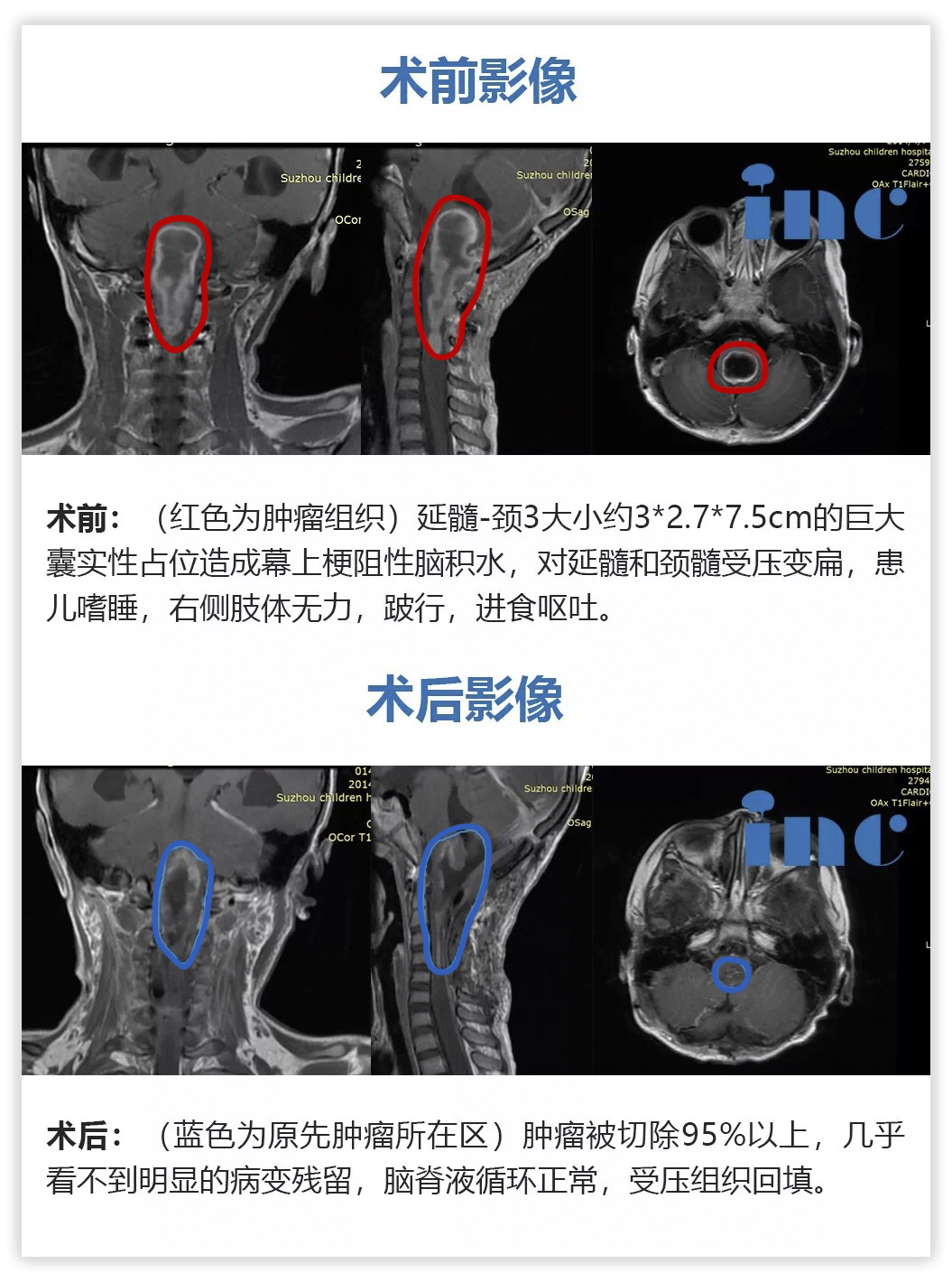 6歲女孩——脊髓-腦干毛細胞星形細胞瘤