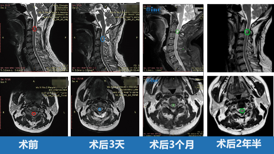 50歲男性——脊髓髓內(nèi)室管膜瘤