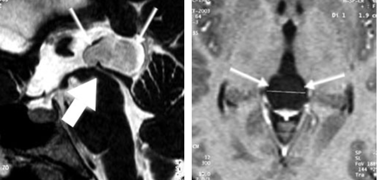 圖6：松果體囊腫的 MRI(矢狀切面和軸切面)?？梢钥吹綄?dǎo)水管(粗箭頭)被囊腫(細(xì)箭頭)移位。