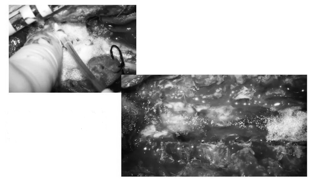 硬膜表面鋪蓋速即棉后生物膠水再次覆蓋，防止腦脊液漏