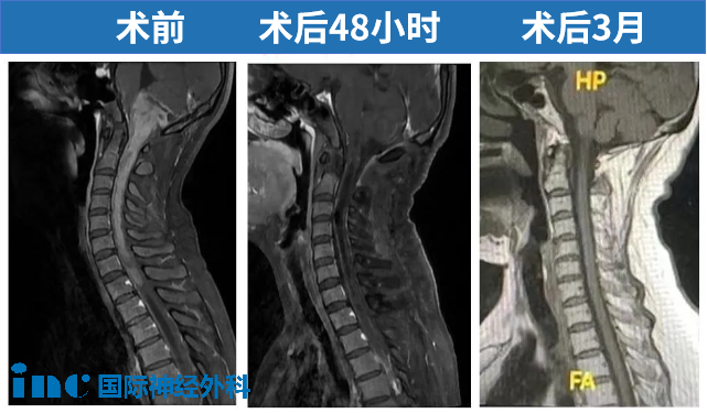術(shù)前術(shù)后MRI對比