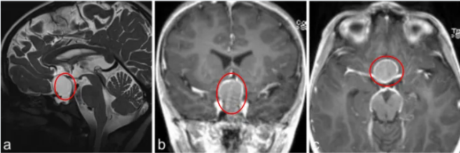 a–c圖MR成像顯示囊性病變對比增強(qiáng)，高度懷疑顱咽管瘤;j、k、l圖顯示，腫瘤得到全切。