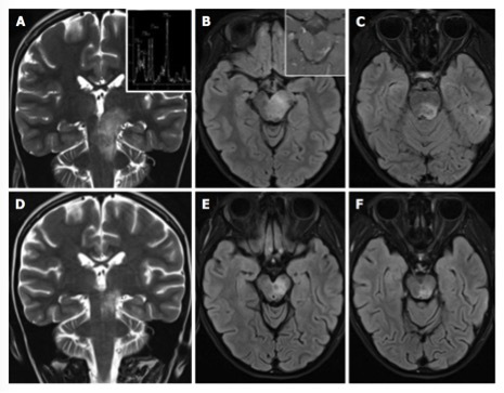 (病毒性腦炎患者，橫斷位T2WI FLAIR示延髓區(qū)域異常高信號)