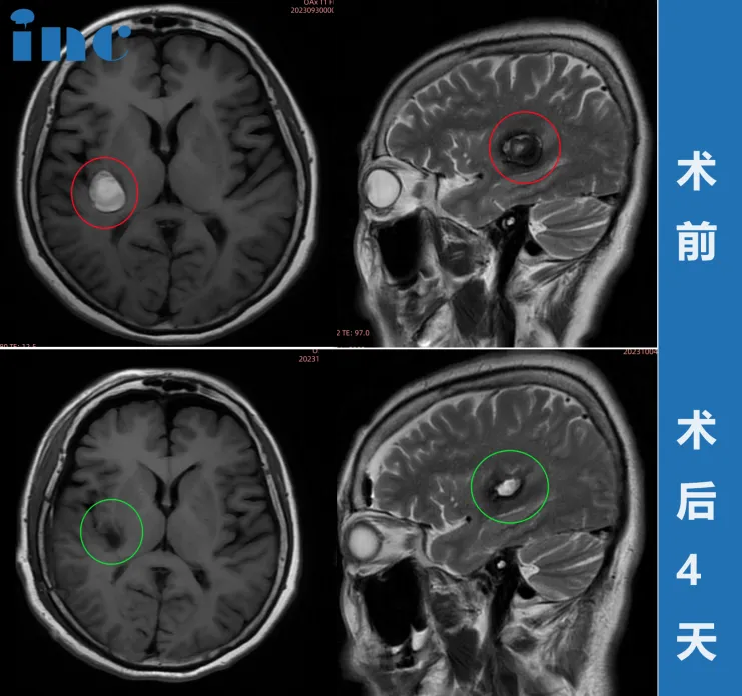術前術后MRI影像