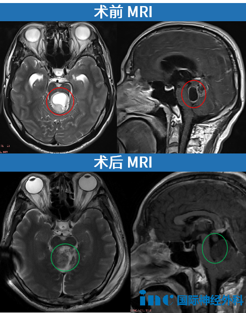 術(shù)前術(shù)后MRI影像
