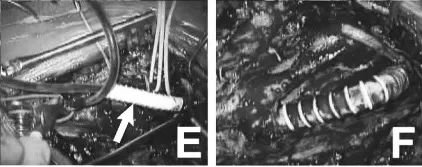 E&F：分流管通過血管假體(雙直徑5mm，長度6cm)(箭頭)，連接頸總動(dòng)脈(CCA)和遠(yuǎn)端ICA，并用血管假體進(jìn)行切除重建。