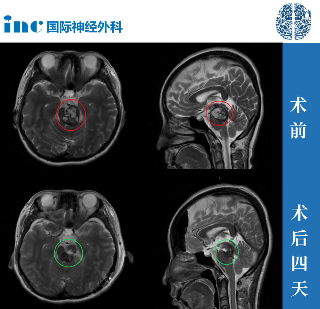 為了能繼續(xù)好好活下去，笑笑這一次選擇了手術(shù)。2024年1月15日，巴教授在蘇州大學(xué)附屬第四醫(yī)院為笑笑進(jìn)行手術(shù)....所有監(jiān)測(cè)都是平穩(wěn)，手術(shù)成功！