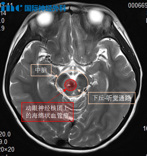 INC巴教授主刀、國(guó)內(nèi)神經(jīng)外科醫(yī)生團(tuán)隊(duì)全力配合下，突破“生命禁區(qū)”，為她順利示范手術(shù)。
