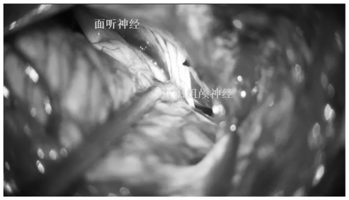充分顯露后組顱神經(jīng)、面聽神經(jīng)及絨球