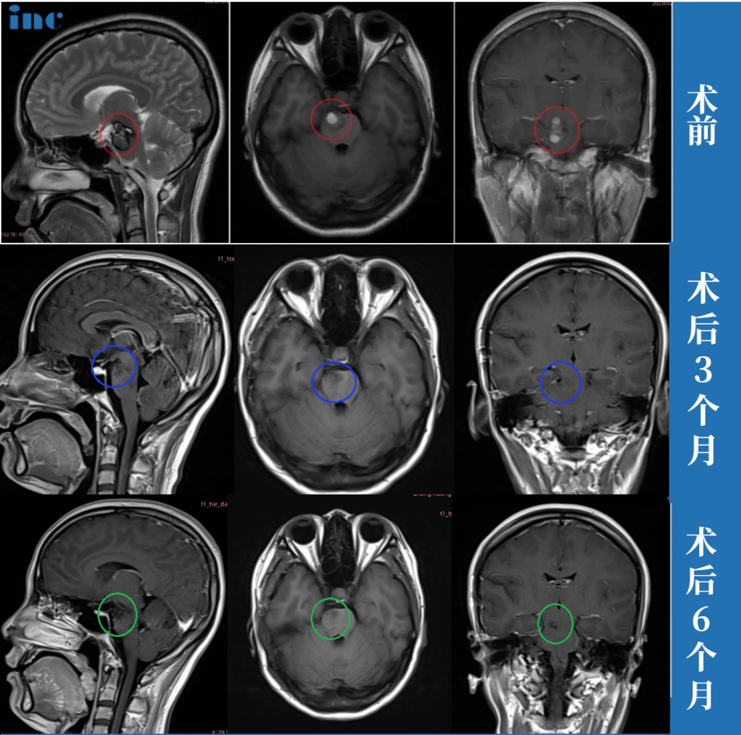 術(shù)前術(shù)后MRI對(duì)比