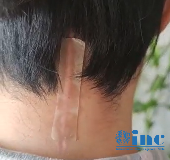 經(jīng)歷了脊髓髓內(nèi)室管膜瘤全切術(shù)后的她狀態(tài)良好，看起來幾乎和常人無異，后腦勺那條細(xì)細(xì)的刀口被美麗的秀發(fā)覆蓋著，別人都想象不到她曾經(jīng)歷過一場高難度的開顱手術(shù)。