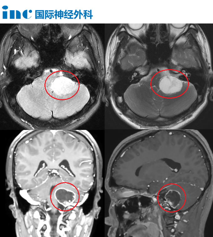 CPA區(qū)和頸靜脈孔區(qū)位置長(zhǎng)了一個(gè)不小的腫瘤