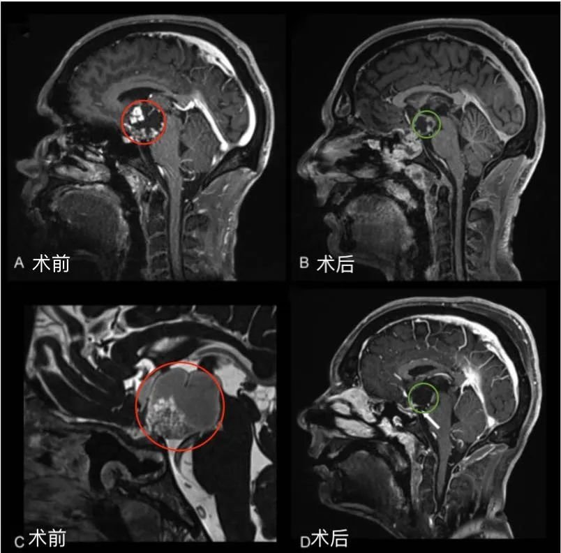 圖1 后視交叉性顱咽管瘤患者腫瘤術(shù)前(A，C)和術(shù)后(B, D)矢狀位增強(qiáng)MR對比，顯示腫瘤全切