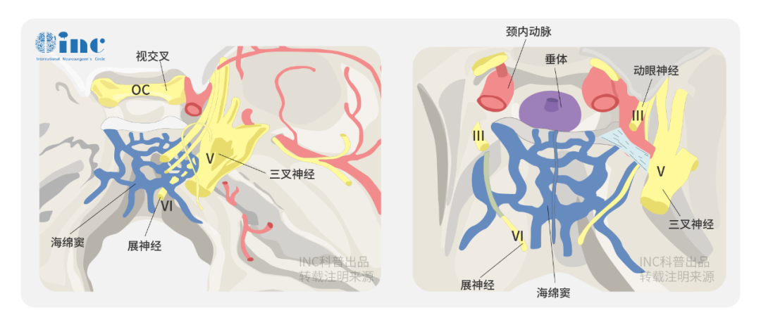  棘手的Meckel’s腔腦膜瘤該如何處理？