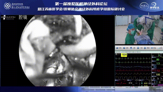 做好術(shù)野止血，注意延髓表面大動(dòng)脈及其分支處理及保護(hù)。