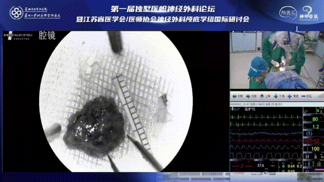 完整海綿狀血管瘤病變?nèi)〕?，腫瘤全切。取出的病變瘤體病變組織大小約1*1cm大小。