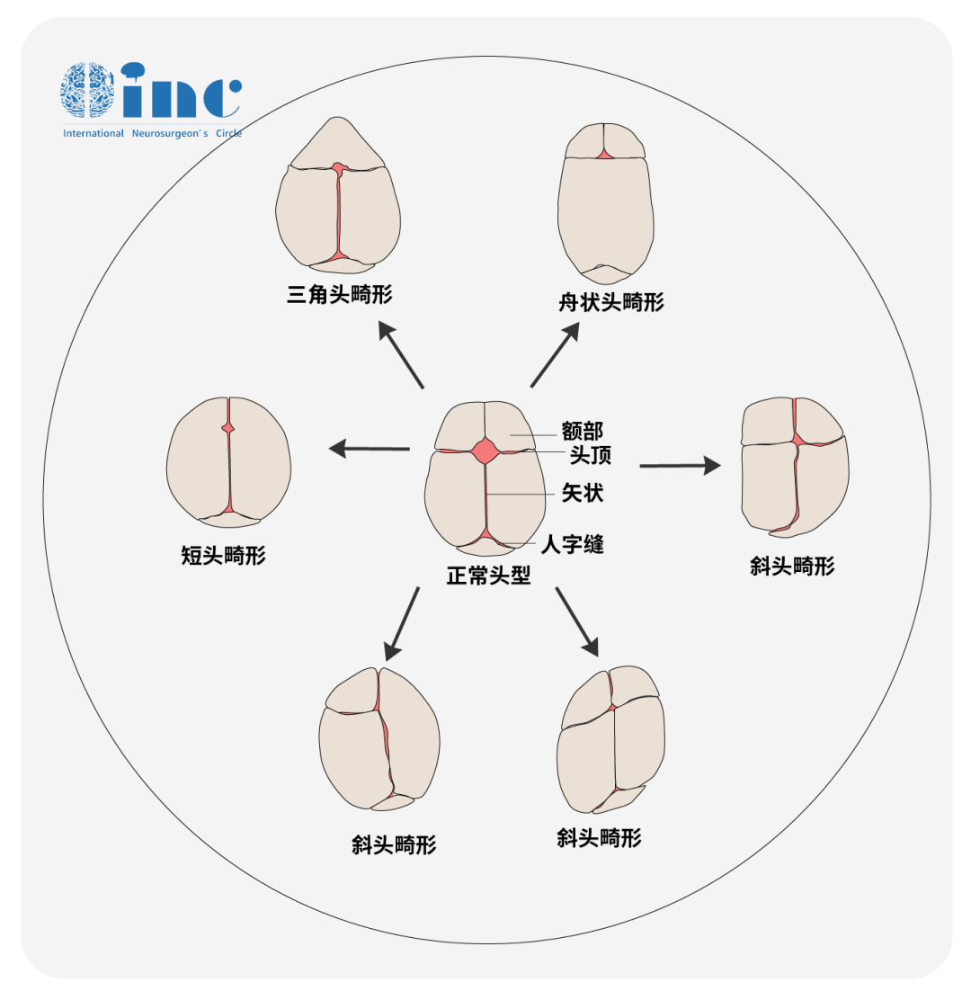 顱縫早閉的早期發(fā)現(xiàn)主要基于異常頭型的主觀識(shí)別
