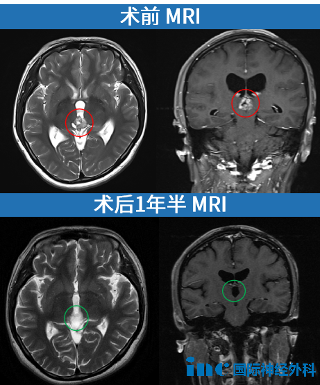 巴教授術(shù)后一年半隨訪結(jié)果顯示——“腫瘤切除完美，第三腦室區(qū)域腫瘤原位置非常干凈。