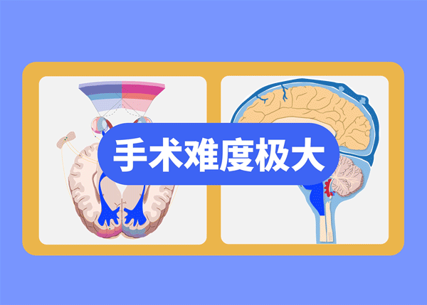 毛細胞型星形細胞瘤
