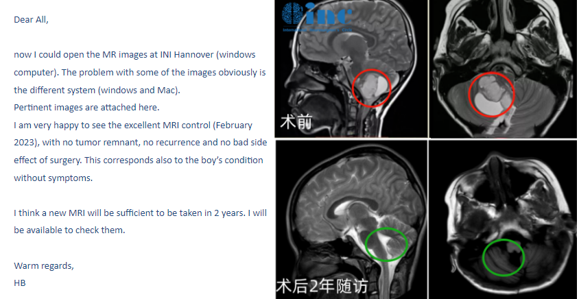7歲男孩——小腦-腦干毛細胞星形細胞瘤