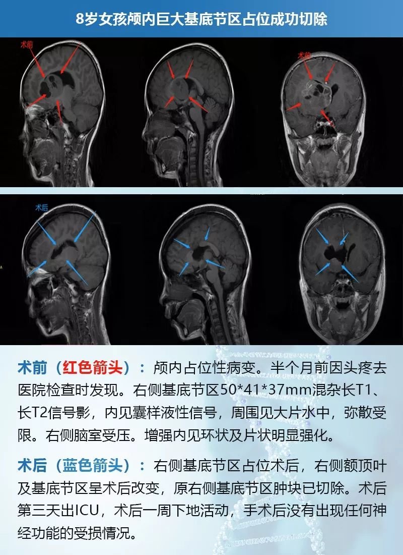 INC巴教授主刀手術(shù)后