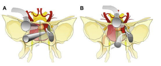 圖示：(A) Binostril 和 (B) 使用有角度器械的單鼻孔入路。旋轉(zhuǎn)軸與吸力角度相結(jié)合，導(dǎo)致手指的小動作在曝光深度上被放大，并允許 360 度范圍。當(dāng)用拇指和中指和無名指控制時，吸力還可以沿前后方向移動。
