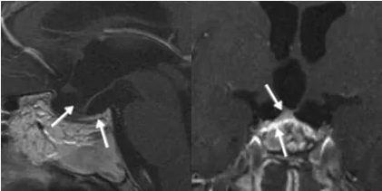 術(shù)后進(jìn)行的磁共振成像（MRI）隨訪檢查表明腫瘤已被完全切除，同時(shí)顯示剩余的垂體腺明顯萎縮但仍保持完整。