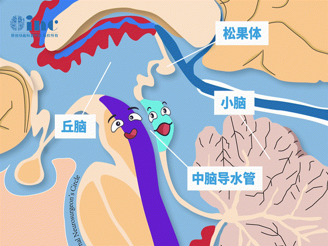 但這個(gè)位置的腫瘤容易直接壓迫中腦導(dǎo)水管，造成梗阻性腦積水，常因腦積水引起的癥狀而被發(fā)現(xiàn)。嚴(yán)重時(shí)導(dǎo)致顱內(nèi)高壓、甚至造成腦疝危及生命。