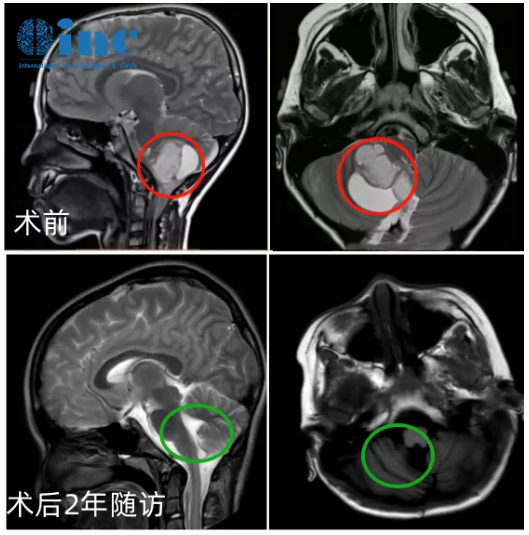 術后兩年隨訪影像