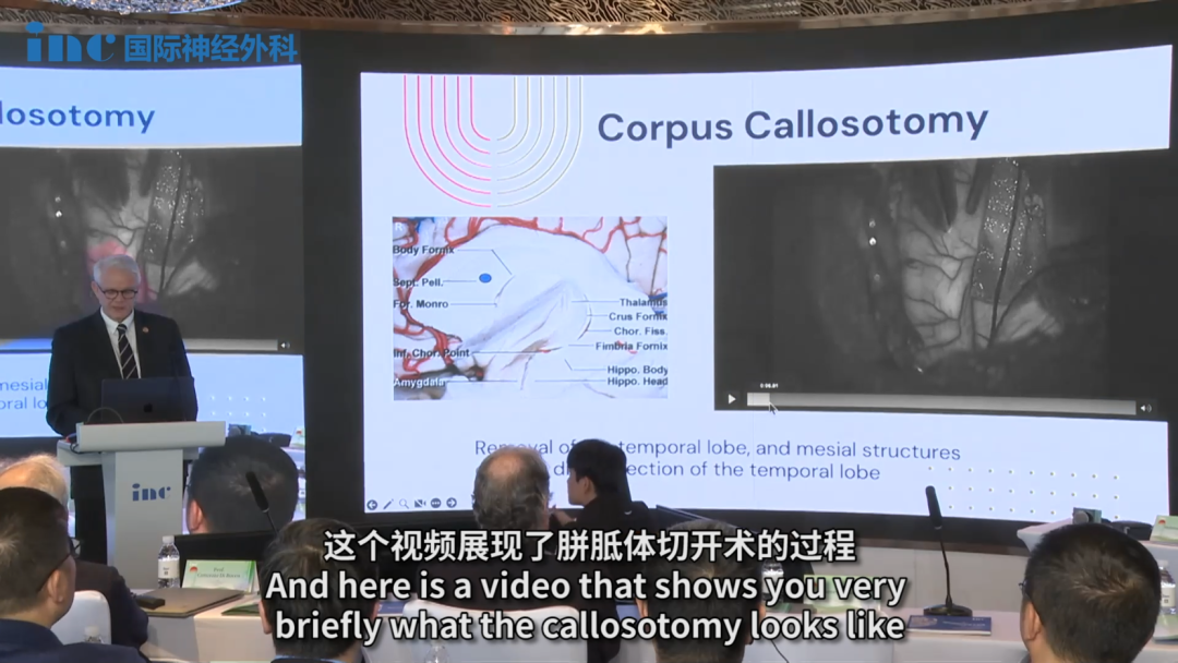 　　這里是室間孔，可以在這里找到胼胝體周圍血管，在室間孔上方約 1 厘米處，即穹窿上方。這個(gè)視頻展現(xiàn)了胼胝體切開術(shù)的過程。
