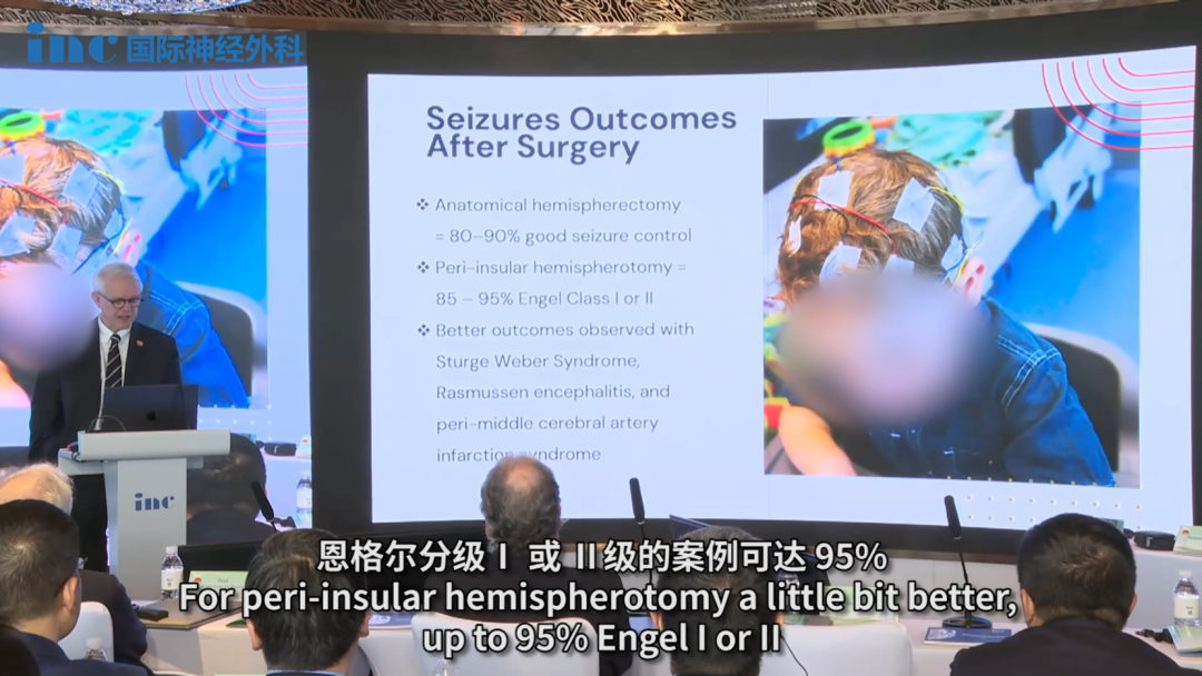 Rutka教授特別指出：“解剖大腦半球切除術(shù)的癲癇發(fā)作預(yù)后良好率約為 80%-90%。對于環(huán)島葉半球切開術(shù)的癲癇發(fā)作預(yù)后良好率會(huì)稍微好一些，恩格爾分級Ⅰ 或 Ⅱ級的案例可達(dá) 95%。而 Sturge-Weber 綜合征、Rasmussen腦炎和大腦中動(dòng)脈周圍梗塞綜合征的治療效果更好。”