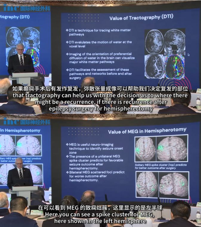 MEG（腦磁圖）對這種情況也非常重要，它可以幫助預(yù)測哪些患兒的半球切除術(shù)后效果良好。