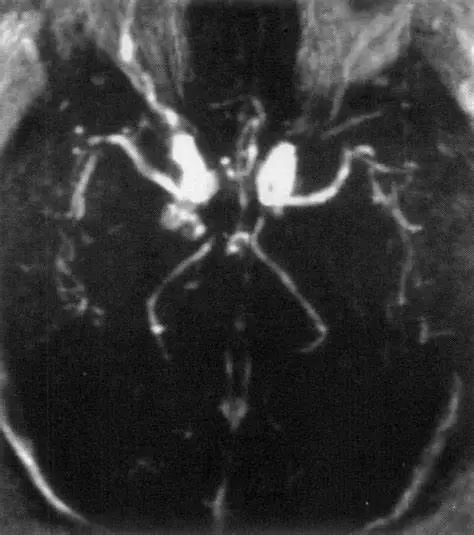 海綿竇動靜脈瘺(Carotid-Cavernous Fistula, CCF)