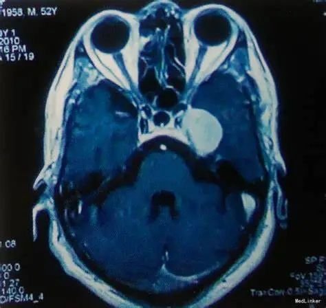 海綿竇區(qū)腦膜瘤（Meningiomas）