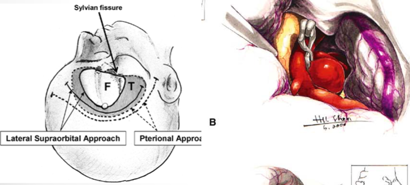 專題一：Lateral Supraorbital Approach for Aneurysmal Clipping