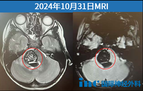 大出血伴隨病灶周圍壓力劇增與水腫蔓延，水腫自延髓迅速擴(kuò)展至中腦。