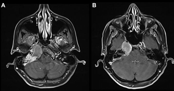 增強(qiáng) MRI 顯示病灶在巖尖、耳蝸和內(nèi)聽(tīng)道側(cè)面和后部出現(xiàn)均勻強(qiáng)化病灶， T2 低信號(hào)和 T1 高信號(hào)，病灶導(dǎo)致右側(cè)內(nèi)聽(tīng)道 ICA 和海綿竇向前移位。