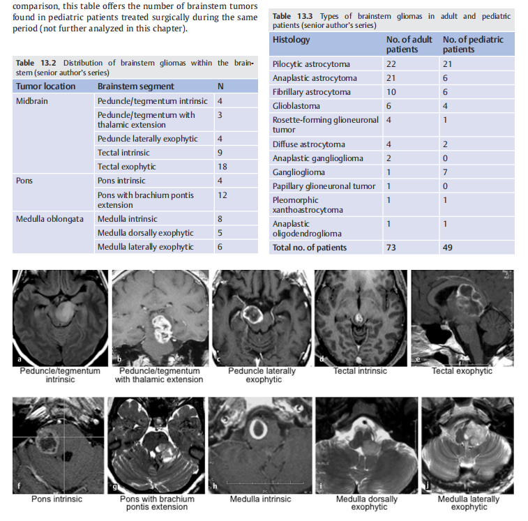 《adult brainstem glioma》(成人腦干膠質(zhì)瘤)