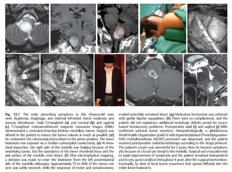 《adult brainstem glioma》(成人腦干膠質(zhì)瘤)
