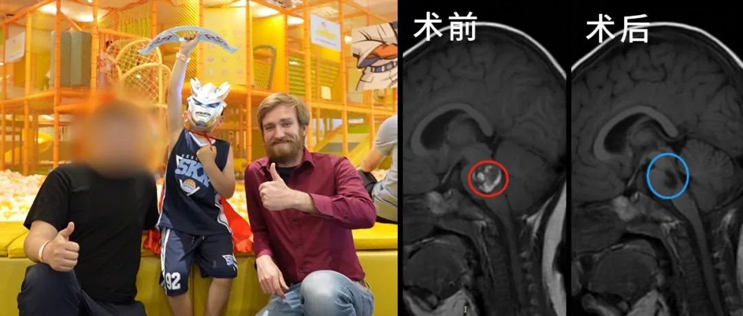 2歲男孩—腦干橋腦海綿狀血管瘤