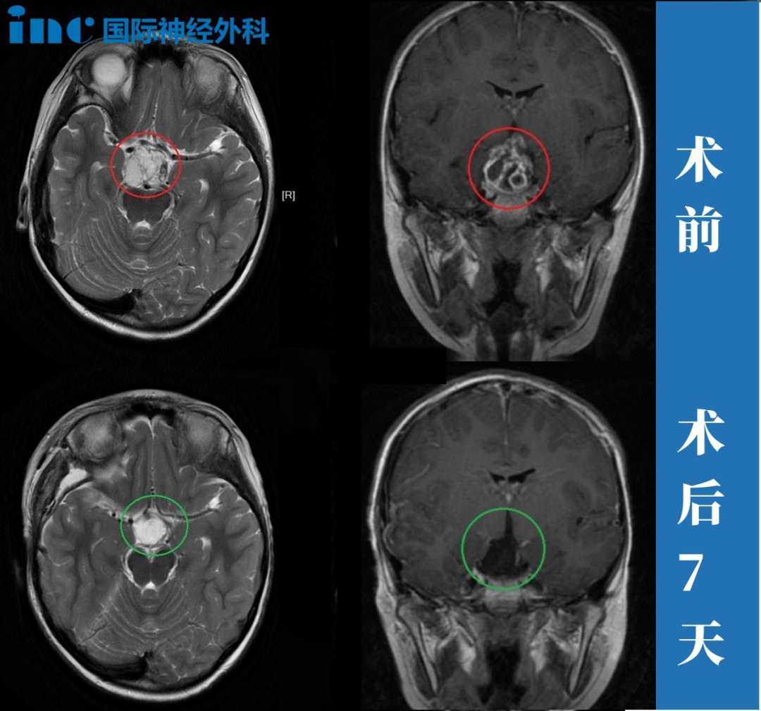 7歲男孩—顱咽管瘤