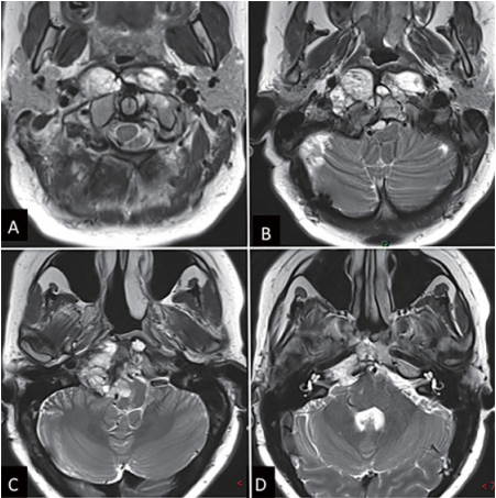 內(nèi)鏡下鼻內(nèi)鏡入路前的術(shù)前影像。(A - D) MRI T2 WI顯示一個巨大脊索瘤延伸至椎前間隙和齒狀突周圍。腫瘤橫向延伸至舌下管和頸靜脈孔，并向內(nèi)側(cè)延伸至硬膜內(nèi)間隙。腫瘤從斜坡中部延伸至樞椎齒狀突周圍。