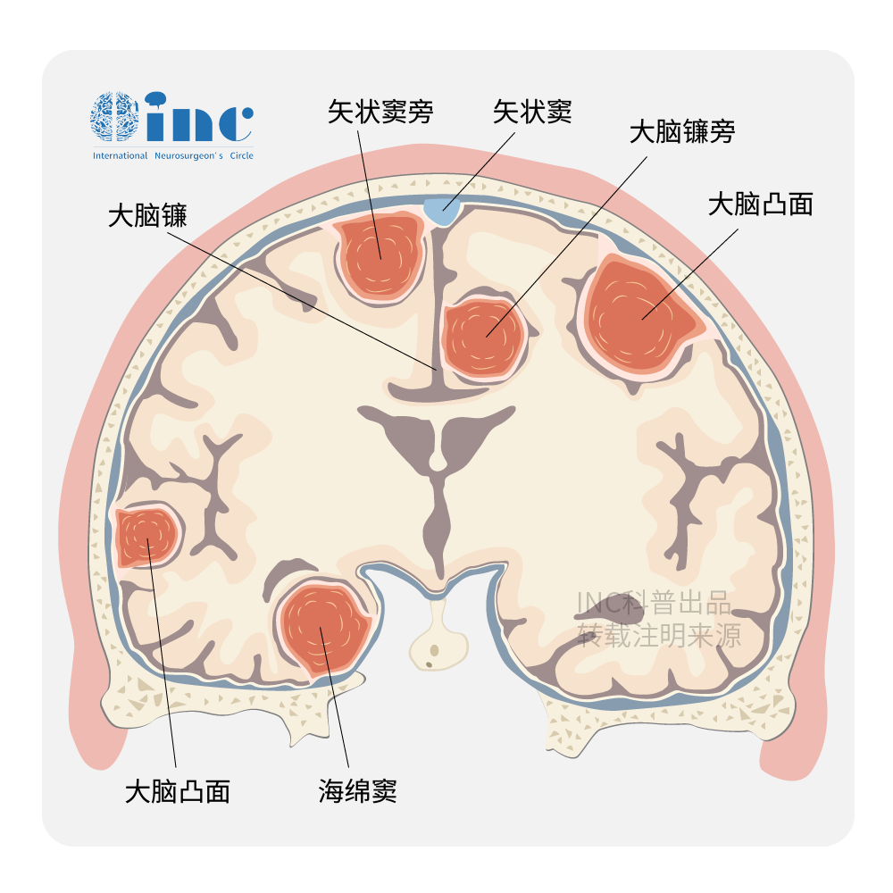 腦膜瘤位置與切除率對(duì)預(yù)后的影響