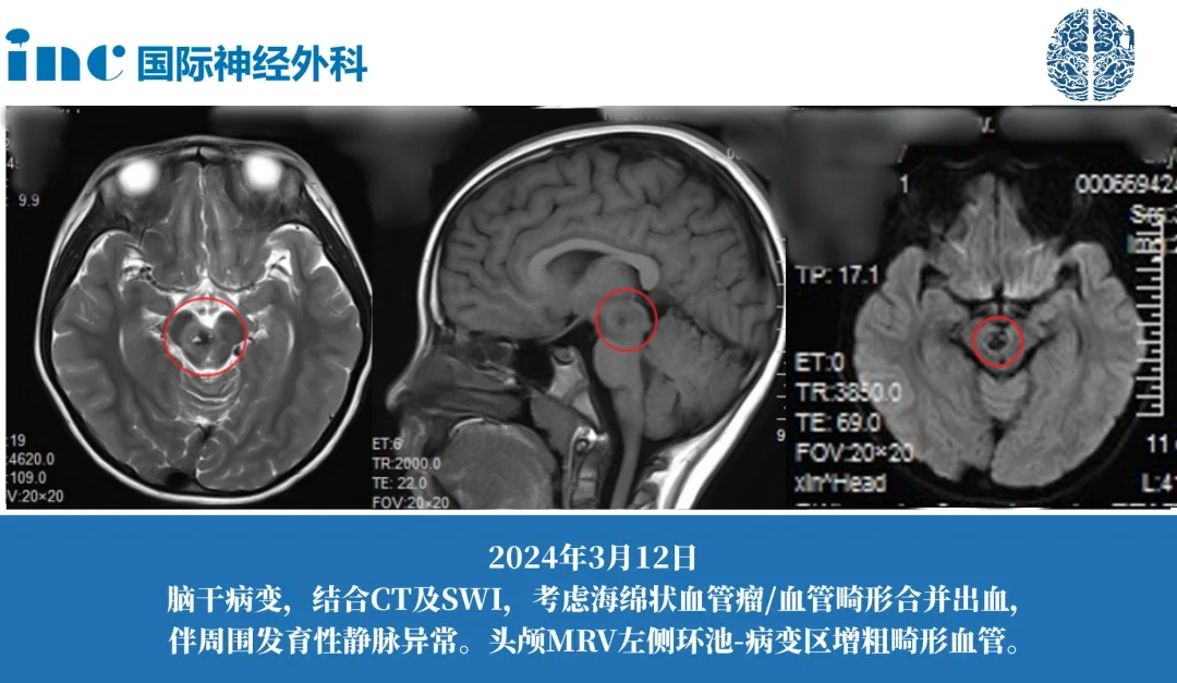 腫瘤影響了動眼神經(jīng)核，這是控制眼球運動的關(guān)鍵區(qū)域。受腫瘤影響，果果出現(xiàn)了嚴重的動眼神經(jīng)麻痹，導致她的一只眼睛無法正常開閉，并且瞳孔異常擴大。醫(yī)生們提示，手術(shù)中如果動眼神經(jīng)核受到進一步損傷，可能會導致果果的視力永久受損。