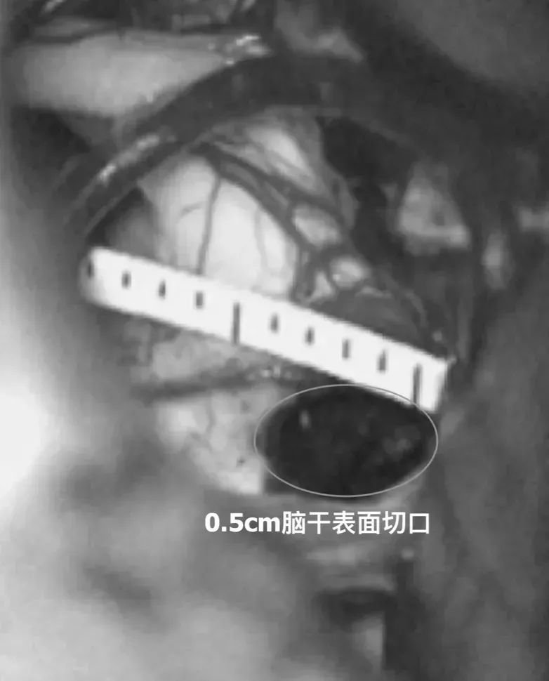 圖：全切病變后，直尺測量經(jīng)腦干切除病變切口為3cm