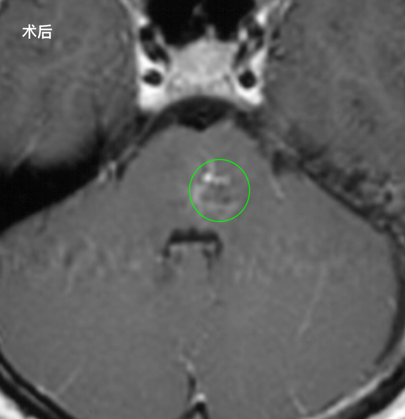 圖：術(shù)后復(fù)查MR顯示腦干病變成功全切，未遺留腦損傷。