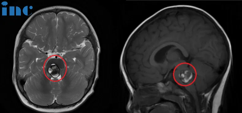 術前：腦橋占位。雙眼斜視、畏光，面癱，頻發(fā)不自主扭頭動作，走路稍有不穩(wěn)。頭顱MR (紅色區(qū)域) 顯示: 腦橋血腫，可見16 x 22 x 21mm腫塊，第四腦室受壓變窄。