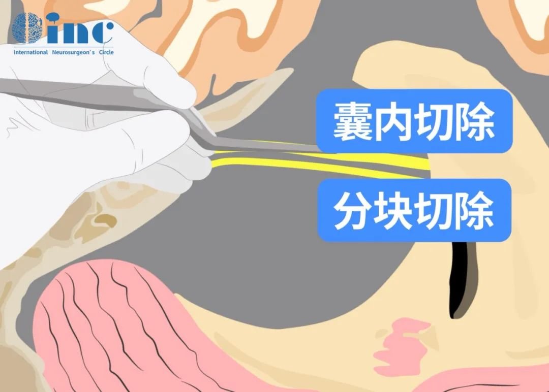 膜內(nèi)腫瘤切除術(shù)
